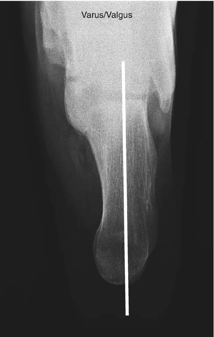 Cureus | Open Reduction and Internal Fixation of a Pediatric Apophyseal  Calcaneus Fracture Using Cannulated Screws: A Case Report | Article