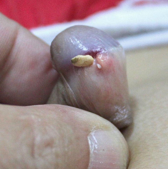 Preputial Cysts | SpringerLink