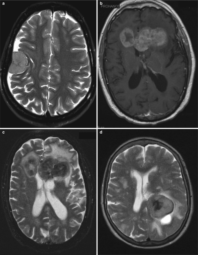 Figure 54.8 from Brain CT and MRI: differential diagnosis of imaging  findings. | Semantic Scholar