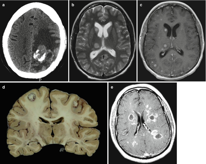 Case 1 History: Middle-aged man with no significant PMH became confused and  disoriented. Head CT showed a brain mass. He was transferred to UNC. - ppt  video online download