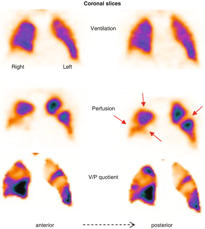 Ventilation/Perfusion SPECT Imaging Diagnosing PE and Other Cardiopulmonary  Diseases | SpringerLink