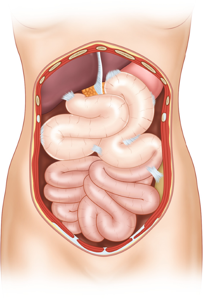 Laparoscopic Lysis Of Adhesions And Bowel Obstruction | Springerlink
