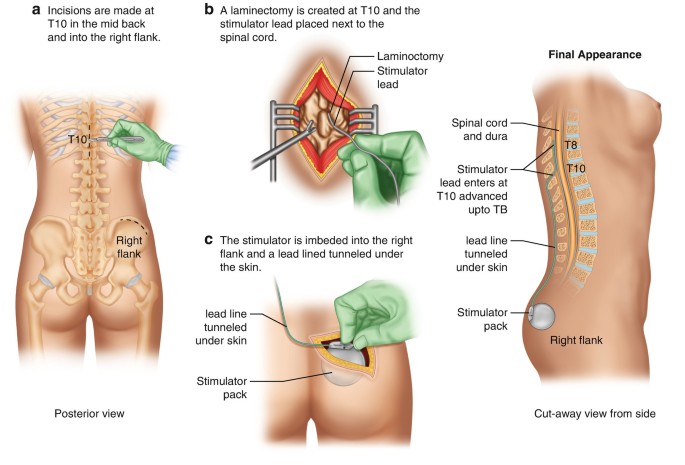 Patient with a Spinal Cord Stimulator | SpringerLink