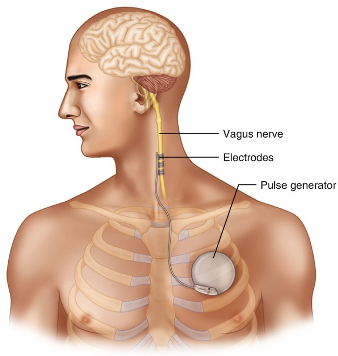 Understanding Vagus Nerve Stimulator (VNS) Placement