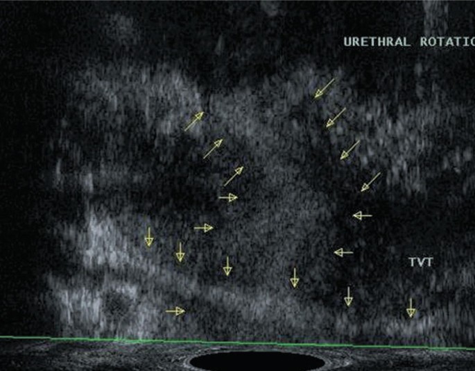 Sonographic findings in acute urinary retention secondary to