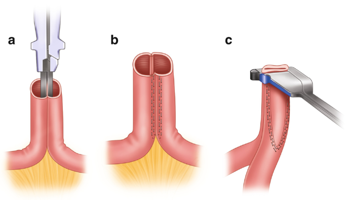 Loop Ileostomy/Colostomy Reversal | SpringerLink