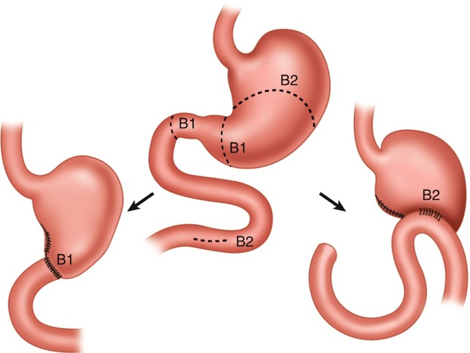 Billroth 2 Gastroenterostomy | SpringerLink