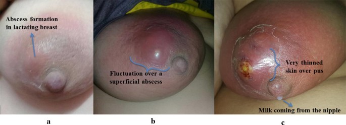 Mastitis, Breast Abscess, and Granulomatous Mastitis | SpringerLink