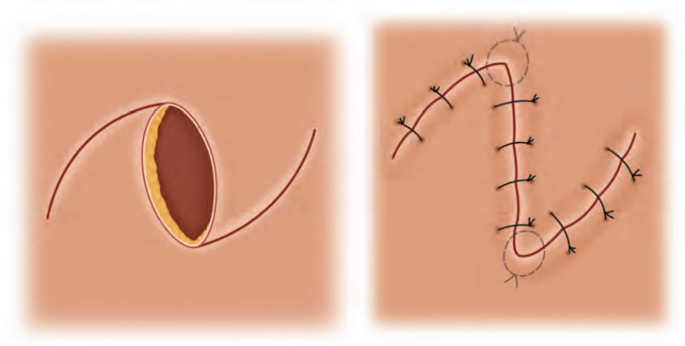 a A temporary-traction 4/0 silk suture is placed to evert the
