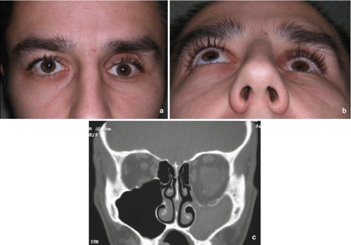 Post-traumatic Enophthalmos and Three-Dimensional Imaging | SpringerLink