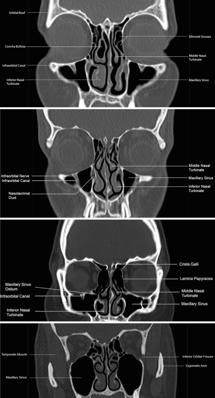 Paranasal Sinuses | Springer Nature Link (formerly SpringerLink), image size:685x1268
