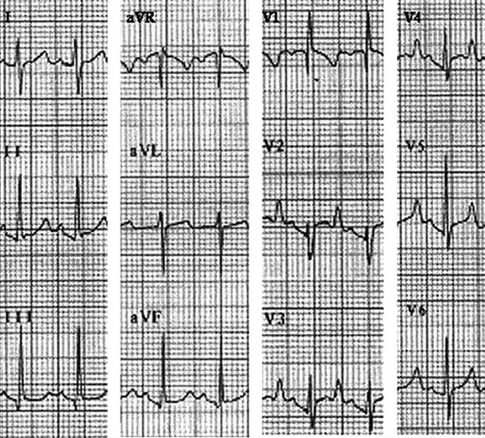 Arrhythmias in Children and Patients with Congenital Heart ...
