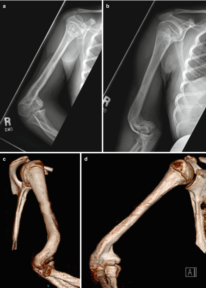 431 Can a bone stimulator help a stress fracture? - DOC