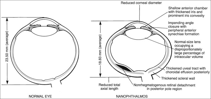 Nanophthalmos: Guidelines for Diagnosis and Therapy | SpringerLink