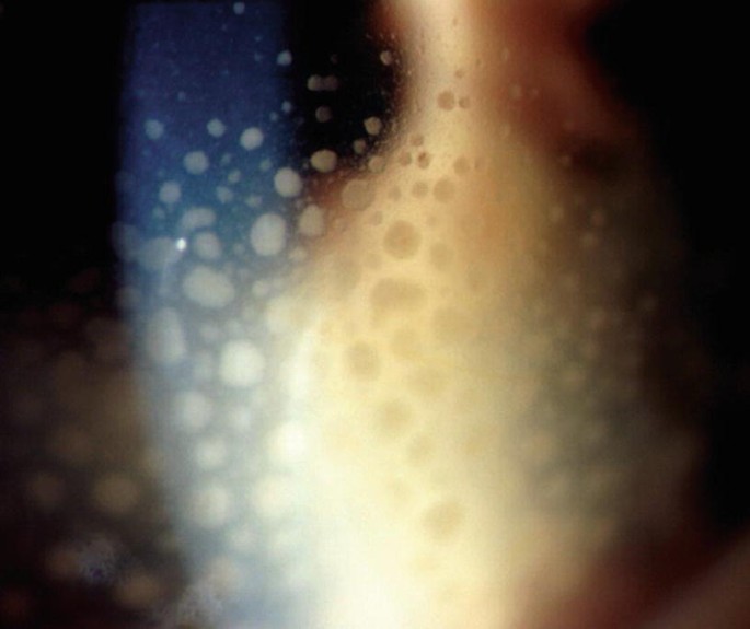 tobacco dust in anterior vitreous Glaucoma Secondary to Anterior Segment Surgery