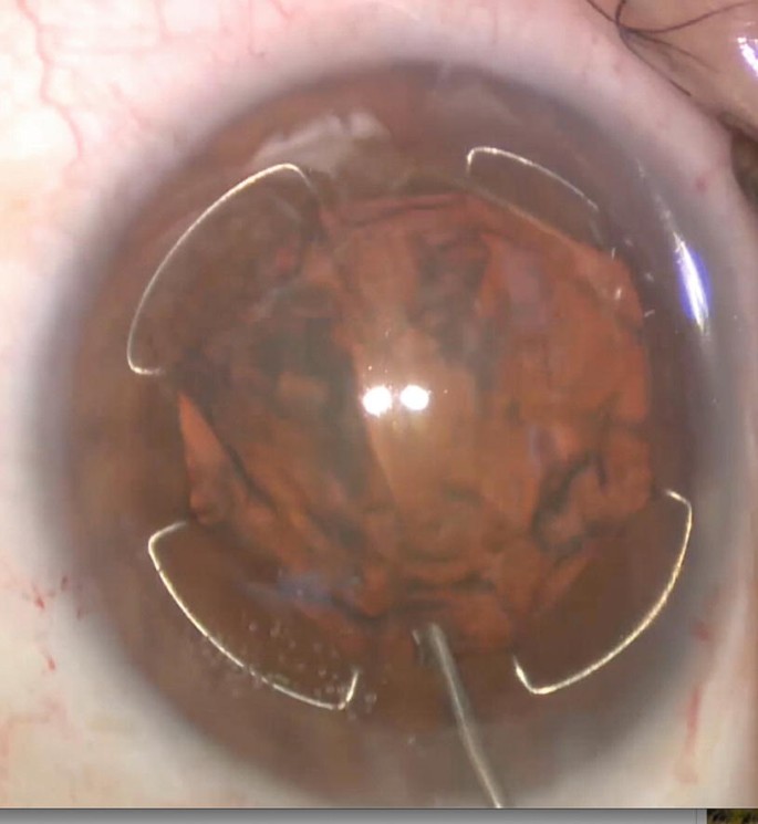 Phacoemulsification In Complex Cases Springerlink