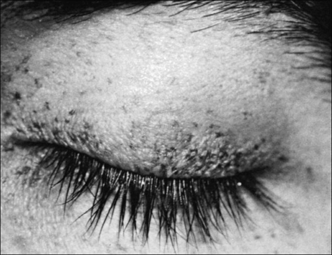 Dangers of Fake Eyelashes  Mitchell Refractive Surgery & Eye Center