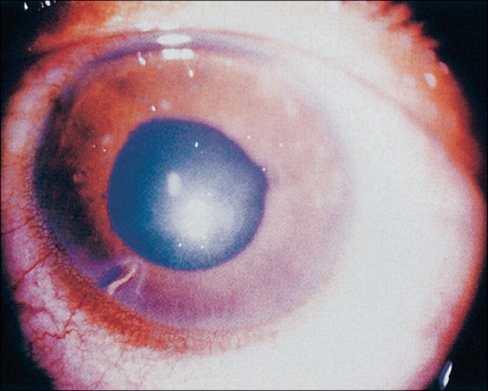 Systemic Parasitic Infections and the Eye