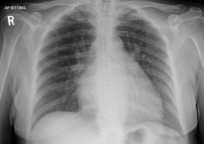 Imaging Of Thoracic And Cadiovascular Emergencies During Pregnancy Springerlink