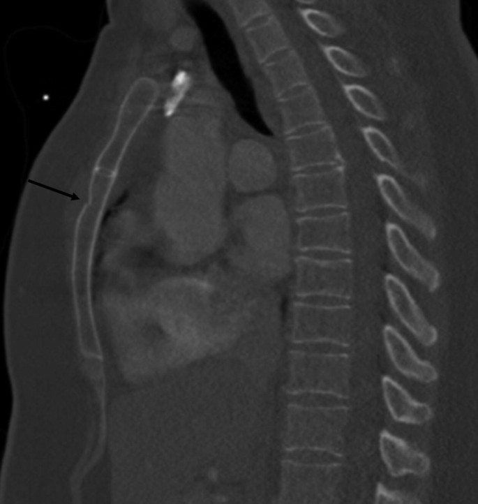 Imaging Of Thoracic And Cadiovascular Emergencies During Pregnancy Springerlink