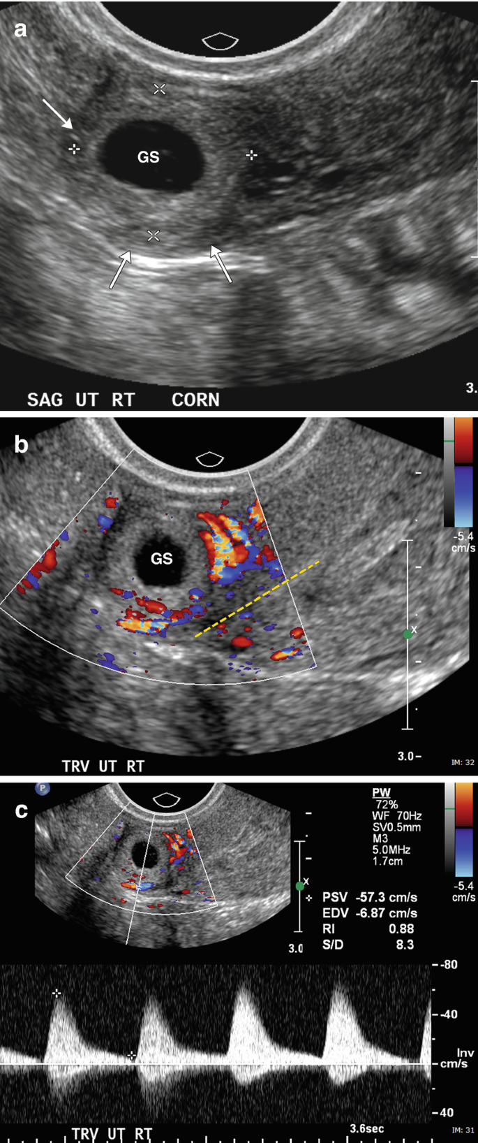 Diagnosis of pancreatic tumors by endoscopic ultrasonography