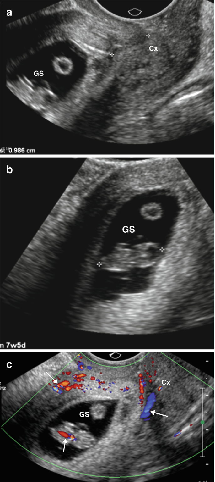 JCM | Free Full-Text | The Use of Methotrexate and Mifepristone for  Treatment of Interstitial Pregnancies: An Overview of Effectiveness and  Complications