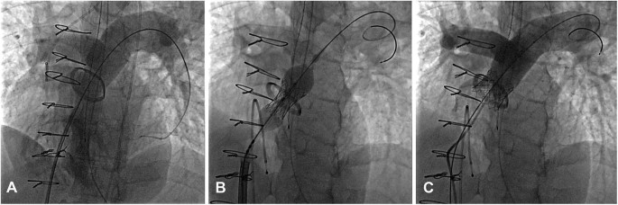 Abdominal aorta stent - sinus-XL Flex - OptiMed - descending thoracic aorta  / vena cava / nitinol