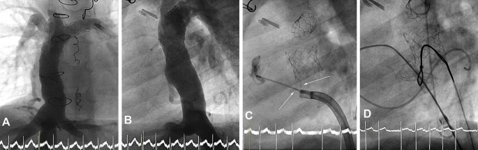 Abdominal aorta stent - sinus-XL Flex - OptiMed - descending thoracic aorta  / vena cava / nitinol