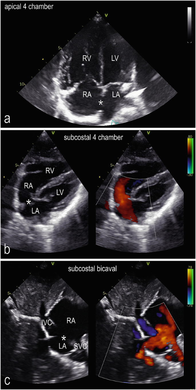 Atrial Septal Defects | Springer Nature Link