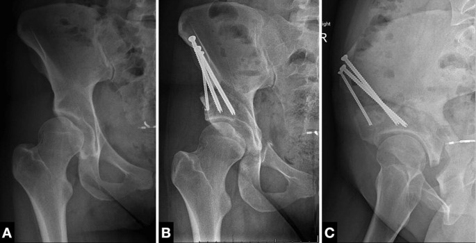 Rehabilitation Guidelines for Use Following a Periacetabular Osteotomy  (PAO): A North American Based Delphi Consensus