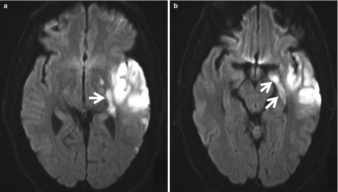 Venous vascular territories of the lateral cerebral cortex (illustration), Radiology Case