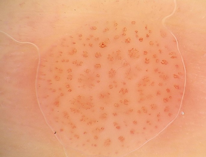 clear cell acanthoma dermoscopy
