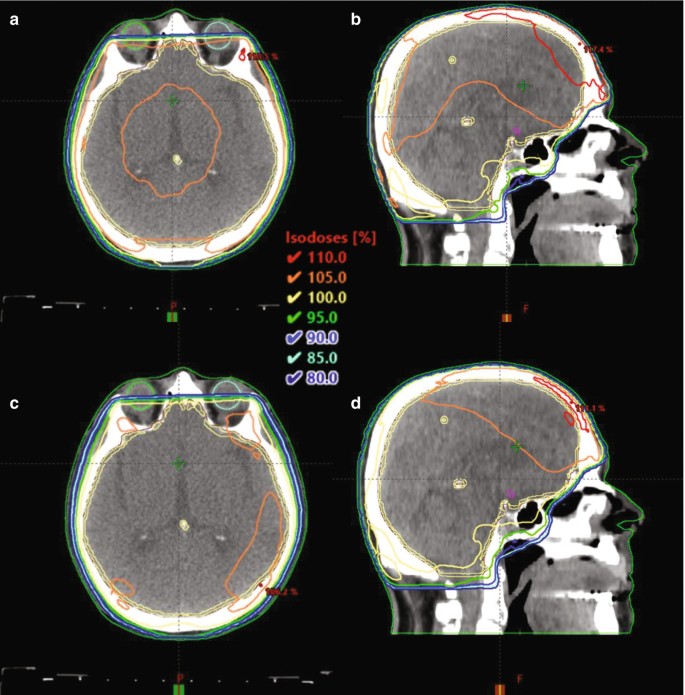 What is Whole Brain Radiation Therapy? 