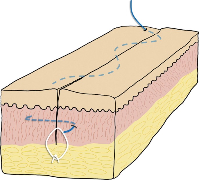 A diagram illustrates a subcuticular continuous suture commonly used for epidermis layer closure.