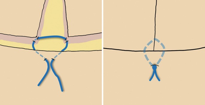 A two part diagram illustrates a three-point U suture used in the T area at mastopexy.