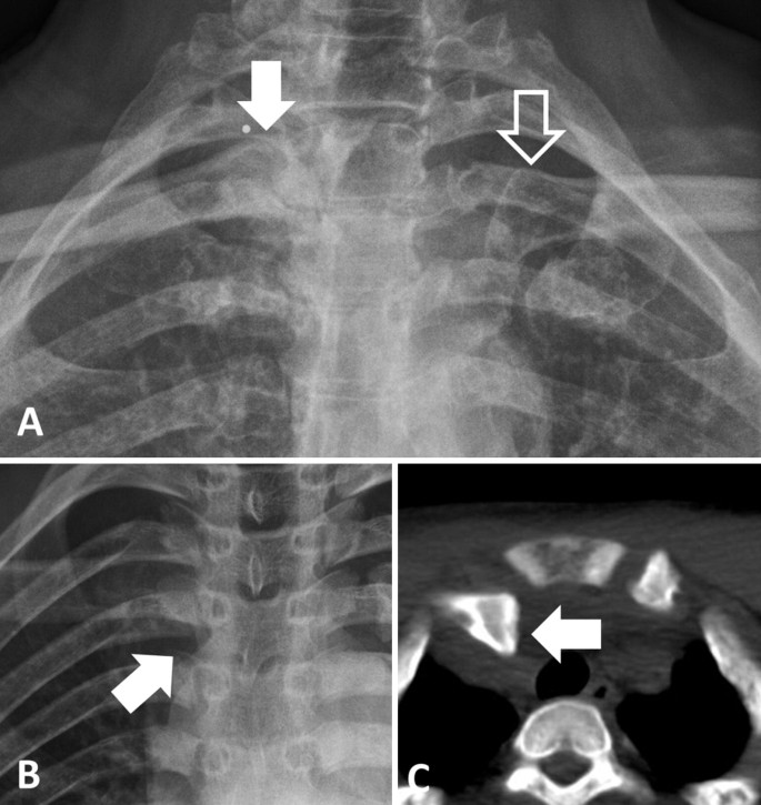 Shoulder Soft Tissue Injuries