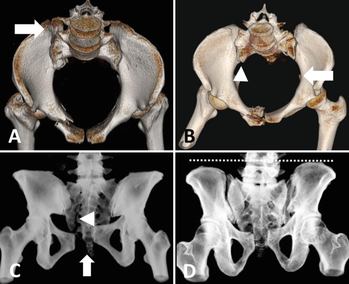 Open book pelvic injury, Radiology Reference Article