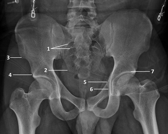 sacrum anatomy xray