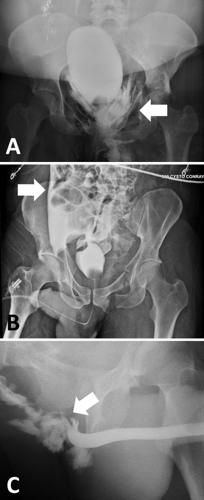 Open book pelvic injury, Radiology Reference Article