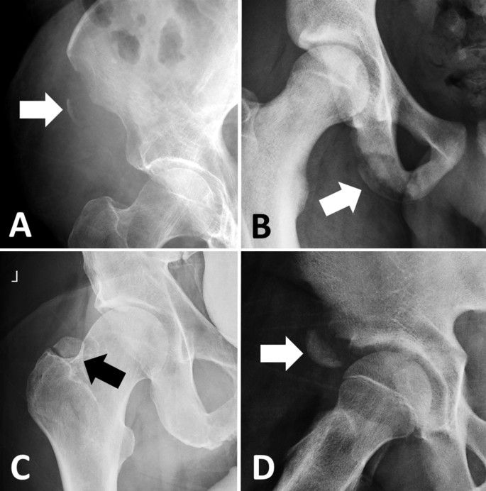 Imaging of Pelvis and Hip Trauma | SpringerLink