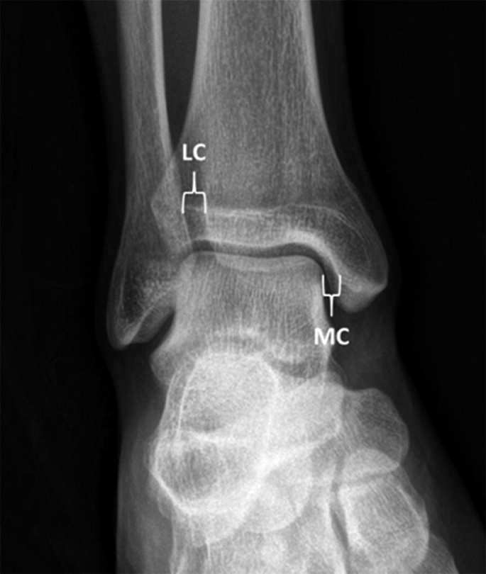 Deltoid ligament of the ankle  Radiology Reference Article