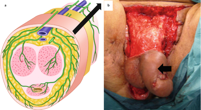 Surgical Techniques: Dorsal Slit Surgery for Clitoral Phimosis