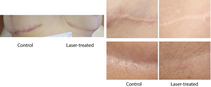 Infect Challenge episode Clinical Case Reports: Scar Prevention by Laser Treatment in Mastopexy With  Implant | SpringerLink