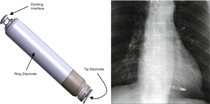 DVNE PaceMaker