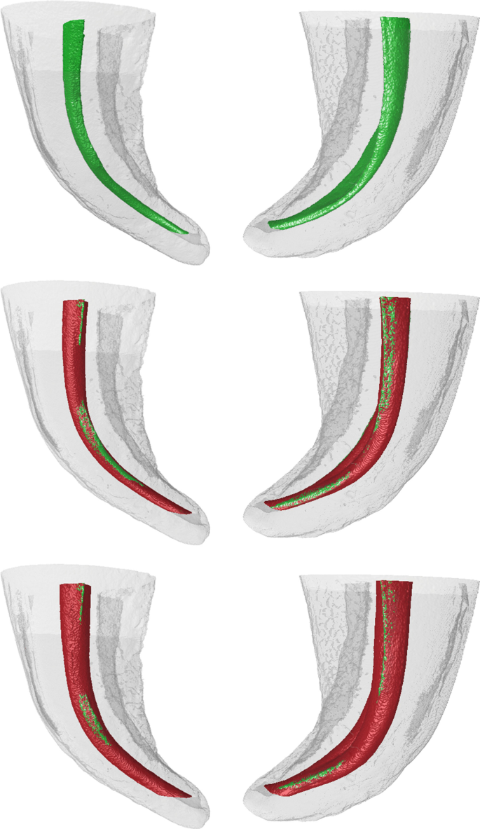 3D reconstructions showing microcracks in the mesial roots of