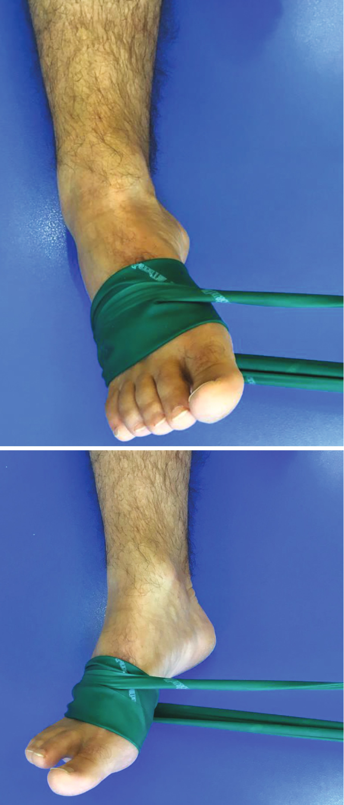 Immobilization and Rehabilitation After Surgical Treatment of Peroneal  Tendon Tears and Ruptures