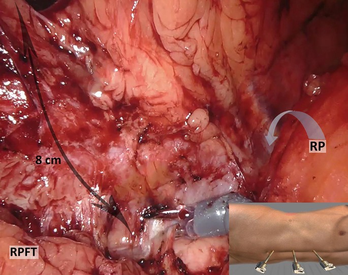 Robotic Lumbar Hernia Repair: Totally Extraperitoneal (TEP)