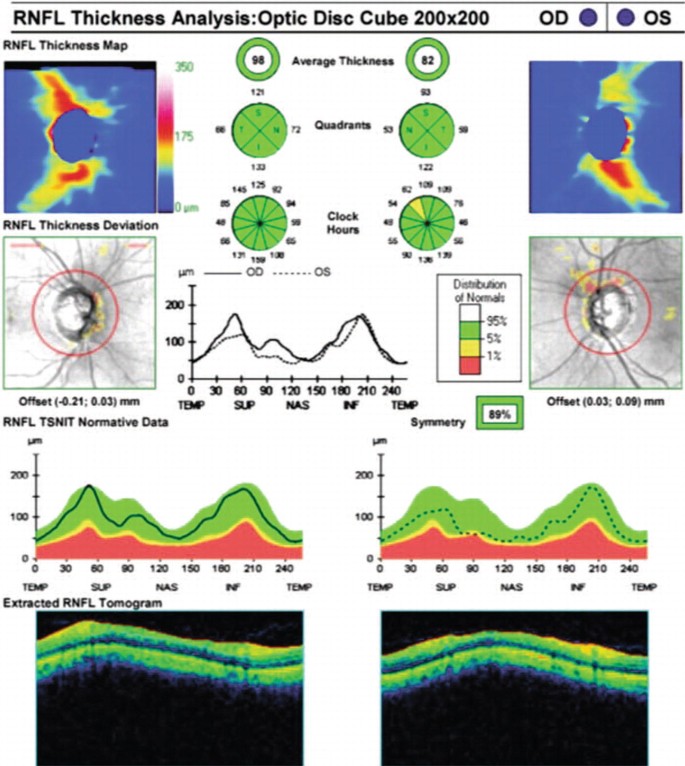 Red Disease: Is it Haunting Your Glaucoma Diagnoses?