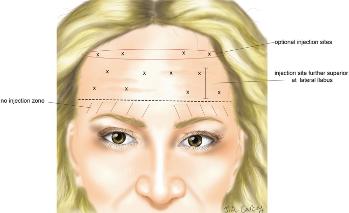 New Trends in Forehead and Brow Lift | SpringerLink