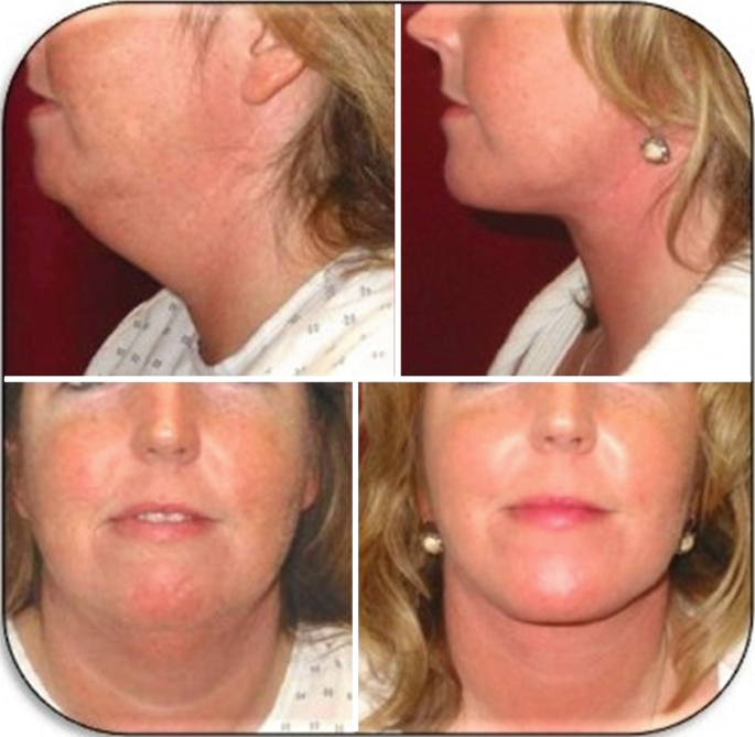 38 F After Liposuction Neck and Back